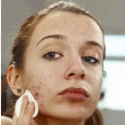 3.acne